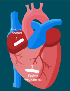 Herz mit 2 Schrittmachern