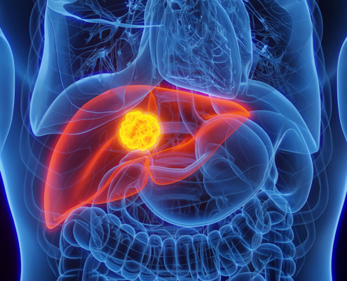 Hepatitis C Leber Illustration