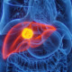 Hepatitis C Leber Illustration